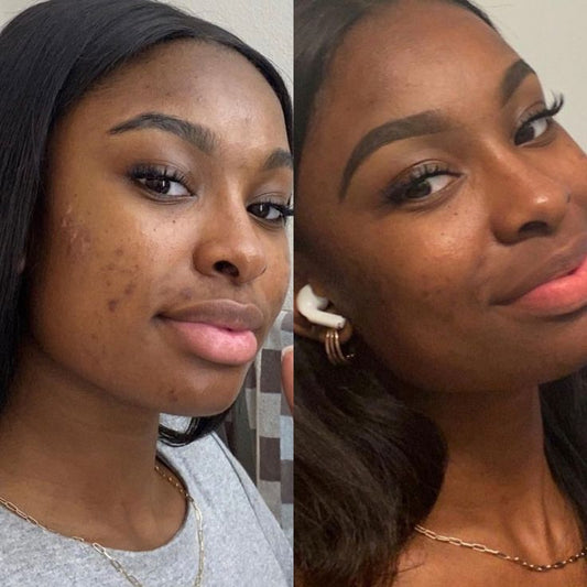 Natural shea butter changed my life forever🌿